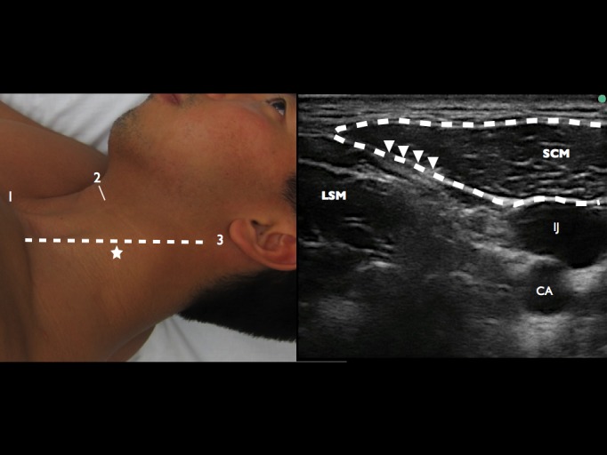 Horner’s Syndrome after Superficial Cervical Plexus Block - The Western