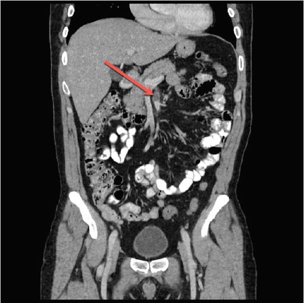 Isolated Dissection of the Superior Mesenteric Artery - The Western