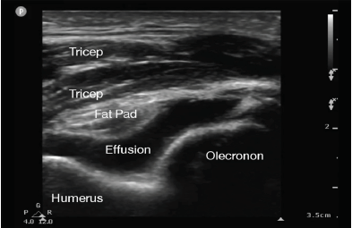 Point-of-Care Ultrasound-Directed Evaluation of Elbow Effusion - The