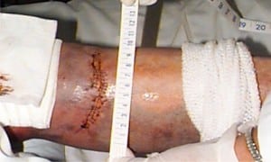 Figure 3. Left lower extremity laceration due to contact with car alarm LED
