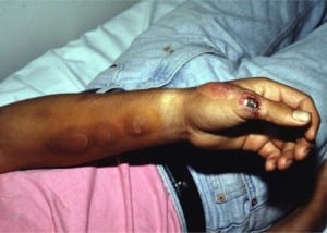 Figure 1. Lymphocutaneous sporotrichosis. 