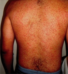 Figure. Diffuse rash consisting of multiple, small, erythematous, and confluent macules.