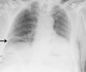 Figure. Chest radiograph suggestive of a pneumoperitoneum, with an elevated right hemidiaphragm and subdiaphragmatic free air.
