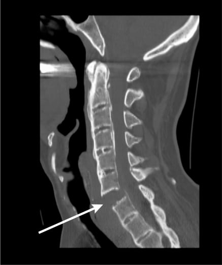 abnormal cervical spine x ray
