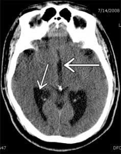 Figure 1. Hydrocephalus with enlarged lateral and third ventricles on computed tomography.