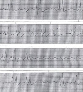 Figure 1. Rhythm strip of lead II demonstrating severe hyperkalemia.