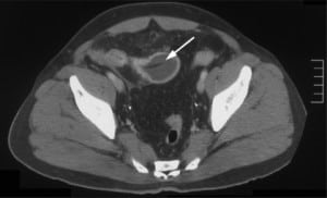 Figure. Computed tomography scan showing a circumlinear food obstruction (arrow) in an ileal stricture with wall thickening.