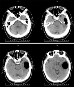 Figure. Computed tomographic image showing large collection of air in anterior portion of the left middle cranial fossa consistent with spontaneous otogenic intracerebral pneumocephalus.
