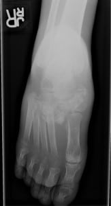 Figure. Dorsoplantar radiograph revealing a Lisfranc dislocation with fragmentation, disorganization and swelling consistent with Charcot foot.