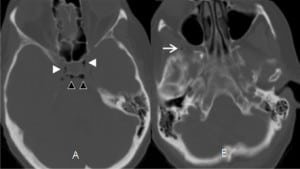 Figure 3. (Case 3). Axial cranial computed tomography through the sella region of an 56-year-old male who presented to the emergency department with the chief complaint of fall after feeling a loss of control of his body. Air is seen in bilateral cavernous sinus (white arrowheads, A), behind the dorsum sella (black arrowheads, A), and right superficial temporal veins (arrow, B).