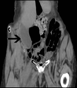 Figure 1. Pelvic computed tomography showing a distended, elongated gallbladder lying in the inferior right hemi-pelvis.