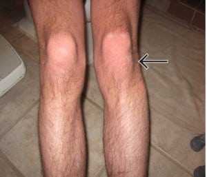 Figure 1. Picture of patient presenting with knee pain and deformity of left lateral knee