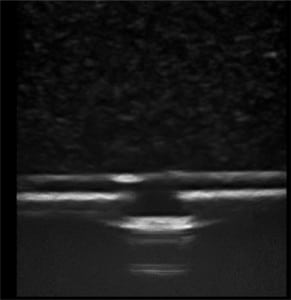 Figure 1. Image of the Blue Phantom™ rubber matrix placed over a two-tiered echogenic structure prior to any needle punctures.