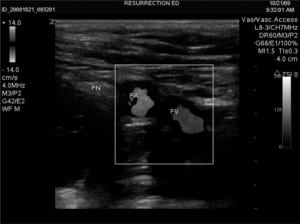 Figure 3b. Ultrasound image of femoral vein (FV), artery (FA), and nerve (FN) with color flow doppler.