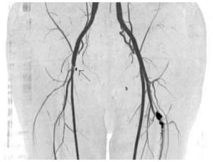 Figure 1. Computed tomography angiogram with three dimensional reconstruction demonstrating a partial occlusion of the right common femoral artery associated with a percutaneous arterial closure device.
