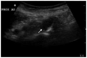 Figure 2. Ultrasound image of the proximal abdominal aorta.