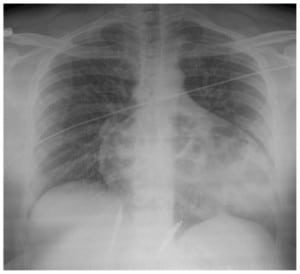 Figure 1. Chest radiograph demonstrating abnormal air shadowing over the enlarged pericardial sac.