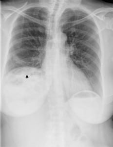 Figure 1. Chest radiograph demonstrating the presence of bowel loops (black arrow) above the liver with apparent elevation of the right hemidiaphragm. These findings were interpreted as bowel interposition by a staff radiologist.