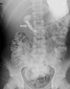 Figure 2. Repeat gastrograffin meal (day 14) showing resolution of gastric outlet obstruction with some residual narrowing of the duodenum and no contrast passes beyond the stomach (arrow).