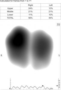 Figure. Components of vibration response imaging include visual and quantitative phonographic characterization of the lungs. In this patient there is bibasilar diminution both in the image (note the darker intensity as well as broader area in the upper lungs) and as quantified in the table.