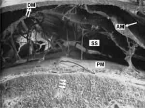 Figure 5b. Photo showing the relationship of the arachnoid (AM, single arrow) easily separating from the dura mater (DM, double arrow) and its relation to the subarachnoid space (SS) and the pia mater (PM). This postmortem photo does not have subdural hematoma (SDH). The PM is closely attached to the brain (triple arrows). Hygroma forms in the SS. Chronic SDH compresses the subarachnoid space and remain closely adherent to the dural border cell layers, which supplies it with blood.
