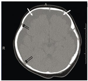 Figure 7. Female, four months old, on admit after apparent life threatening event (ALTE). Note extra space around brain at single arrows: bilateral subdural hygromas filled with cerebral spinal fluid (CSF). This fluid is generally described as “hypodense”or “attenuated” on computed tomography. This darker grey is consistent with density of CSF or a mixture of xanthochromic CSF and older blood. Slightly splayed sutures are noted in several locations (double arrows).