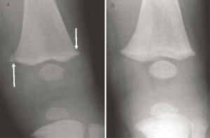 Figure 9. A. The “corner fractures” or classic metaphyseal lesion of L femur seen in vitamin D deficient babies that represents dysplastic growth. In this case the leg was nontender with normal painless range of motion. B. Sixteen days later the findings are resolved without callus formation after vitamin D supplementation.