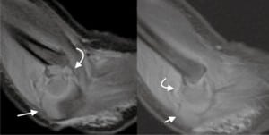 Figure 2. Magnetic resonance imaging demonstrates fracture through the humeral physes with posterior displacement of the cartilaginous epiphysis (curved arrow) but intact articulation with radius and ulna (arrow).