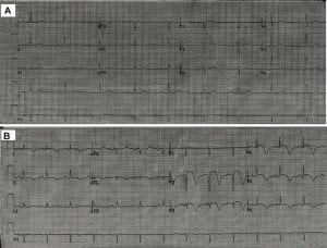 Figure 1. (A) Baseline electrocardiogram (ECG) of patient number one with sinus bradycardia done three months before presentation. (B) ECG of the same patient during the chest pain shows sinus rhythm, ST elevation and diffuse T-wave inversions with QTc prolongation.