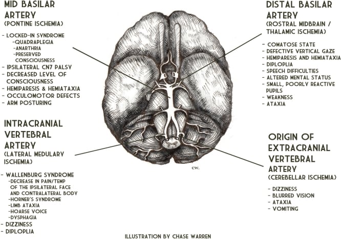 Endovascular Therapy for Stroke Due to Basilar-Artery Occlusion