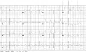 Figure 1. The patient’s electrocardiogram showed a sinus tachycardia with possible left ventricular hypertrophy upon arrival to the emergency department.