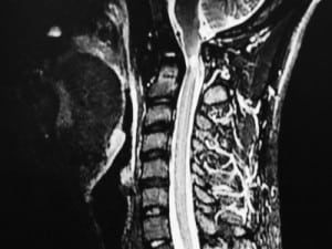 Figure 2. Magnetic resonance imaging of cervical spine. This shows 7 mm of focal myelomalacia at the C1 to C2 level associated with thinning of the cord, compatible with myelomalacia and not definitive acute cord edema. The cord above and below this level appears normal.