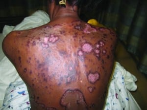 Figure 1. Annular, erythematous rash lined by trailing edge of scale, characteristic of erythema gyratum repens in this 61-year-old female.