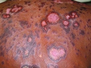 Figure 2. Erythema gyratum repens rash located on the upper back of this 61-year-old female with metastatic adenocarcinoma.
