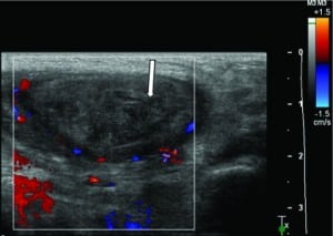 Figure 4. This transverse color Doppler image of the patient's left testicle demonstrates heterogenous echogenicity and no flow throughout the testicle.