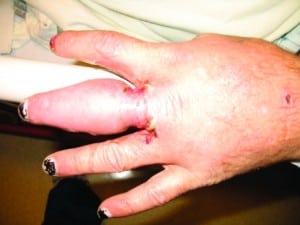 Figure 1. Photograph of the patient's hand on the day he presented to the emergency department after his ring was removed.