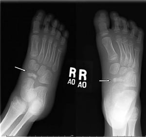 Figure. Radiograph of foot. Arrows point to the navicular bone with avascular necrosis