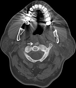 Figure 2. Neck computed tomography bone windows demonstrate the abnormal prevertebral calcium deposit.