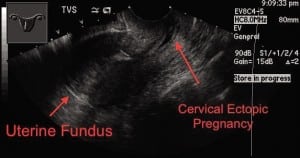 Figure 2. Transvaginal ultrasound in longitudinal plane.