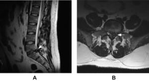 Figure. Sagittal (panel A) and axial (panel B) MRI images demonstrating large central and left paramedian disc extrusion at L5-S1 (arrows) with compression on the cauda equina.