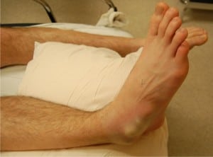 Figure 1. Right foot of a 26-year-old male with a medial subtalar dislocation
