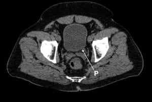 Figure 5b Computed tomography (CT) of the abdomen and pelvis (CT KUB). Inward protrusion (P) of the left posterior bladder wall.
