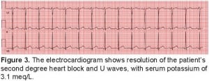 Figure 3. The electrocardiogram shows resolution of the patient’s second degree heart block and U waves, with serum potassium of 3.1 meq/L.