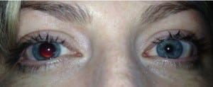 Figure. Photograph of 33-year-old female presenting with asymmetric pupils.