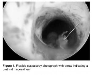 Figure 1. Flexible cystoscopy photograph with arrow indicating a urethral mucosal tear.