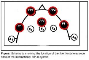 Figure. Schematic showing the location of the five frontal electrode sites of the International 10/20 system.