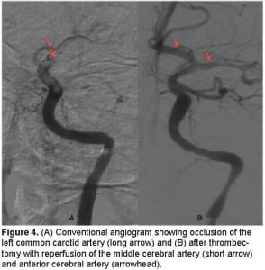 Figure 4. (A) Conventional angiogram showing occlusion of the left common carotid artery (long arrow) and (B) after thrombectomy with reperfusion of the middle cerebral artery (short arrow) and anterior cerebral artery (arrowhead).