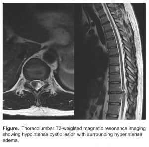 Figure. Thoracolumbar T2-weighted magnetic resonance imaging showing hypointense cystic lesion with surrounding hyperintense edema.