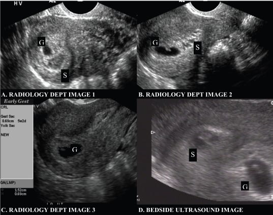 The significance of ultrasound features of sub-chorionic