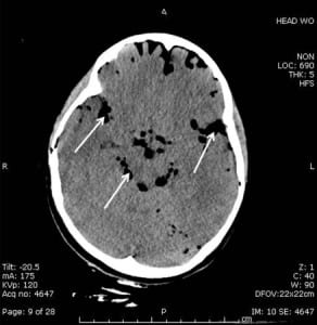 Figure 1 CT image demonstrating severe and widespread air bubbles in the subarachnoid and subdural spaces, as noted by the dark areas and highlighted by the arrows.